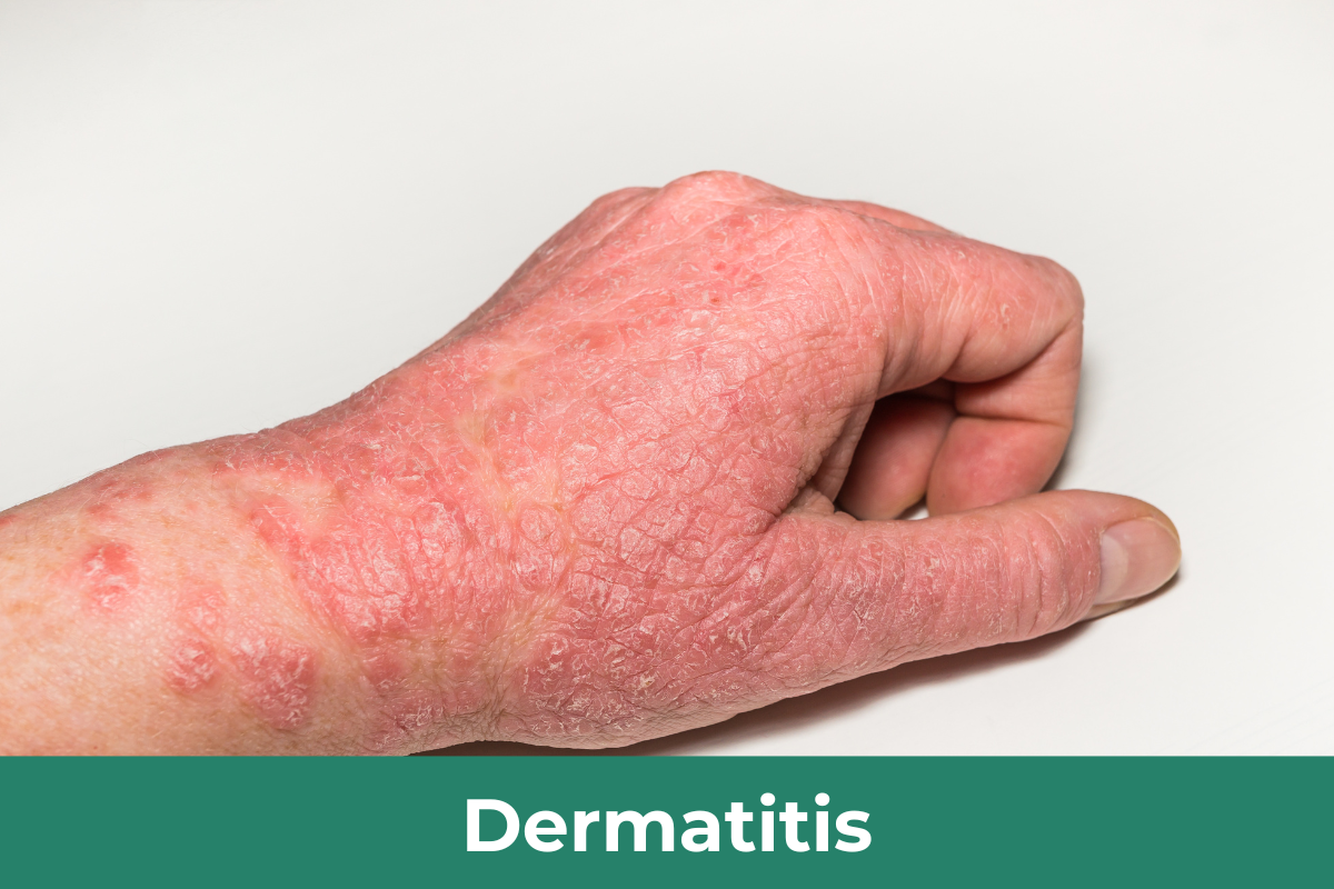 Dematitis