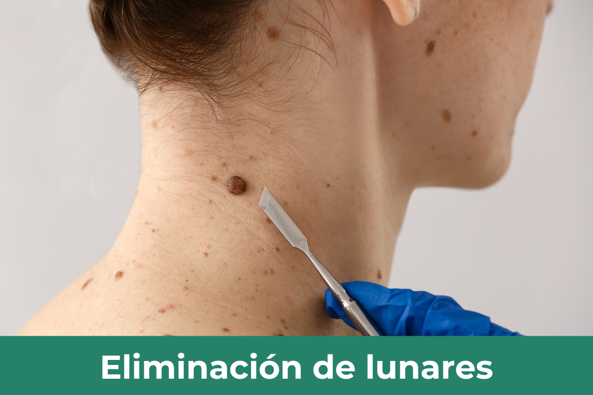 Eliminacion de lunares