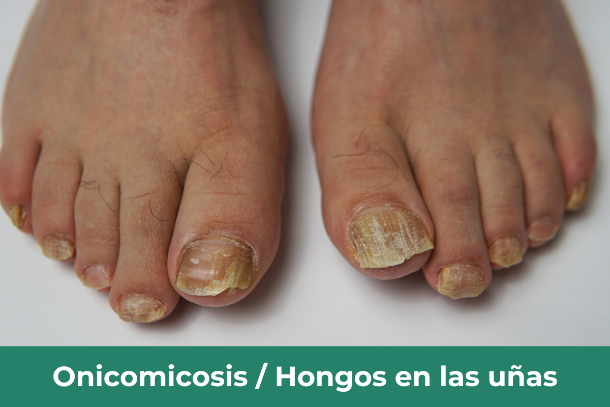 Onicomicosis