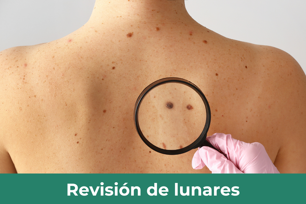 Revision de lunares