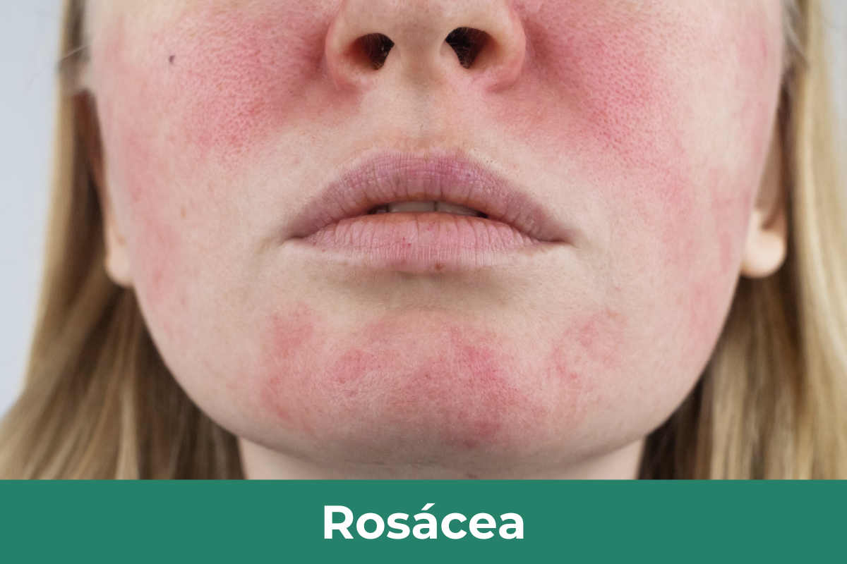 Rosacea